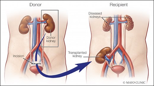 Mayo Clinic Minute: Long-term survival improving for kidney transplant patients - Mayo Clinic News Network