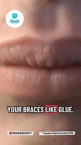 Straightening your smile? 😁✨ Here are the foods you might want to avoid while wearing braces to keep everything safe and smooth! 🦷 Sticky, hard, and crunchy snacks can damage brackets — choose brace-friendly options instead! 📍Domingo velez st. Center point arcade,CDOC ☎️09266824571 #Dentalcare #dentaltips #iToothDental #dentalcarecdo #ToothCareExperts #cdoclinic #CDOdentist #bracestips #BracesCare #DentalTips #ItoothDental | ITooth Dental Clinic