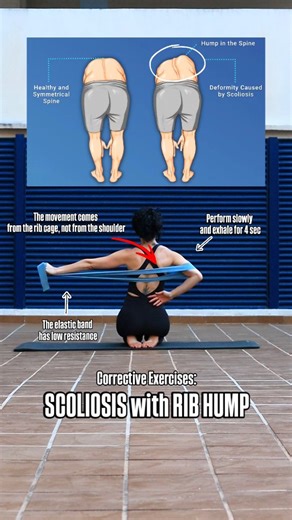 A rib hump in scoliosis is a visible asymmetry of the rib cage caused by spinal rotation, where one side of the ribs protrudes more than the other. It occurs because scoliosis is a three-dimensional deformity, involving rotation as well as side bending, and is often more noticeable during forward bending. Proper scapular stabilization helps reduce excessive scapular movement over the rib cage and limits further asymmetrical loading during daily activities and exercise. Be Healthy!💜 - - #scolios