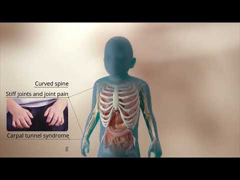 An Inside look at Mucopolysaccharidosis Type I (MPS I)