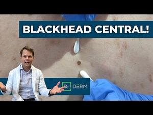 Blackhead Central! | Dr. Derm