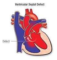 Increased Pulmonary Blood Flow Defects