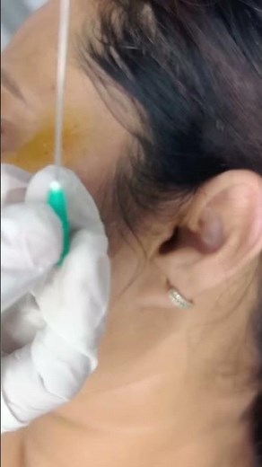 How to extract milia #miliaextraction #milia #dermatology