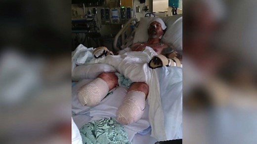 13K views · 55 reactions | A Wisconsin man lost both of his legs after an infection spread all over his body. His doctor believes the infection was likely caused by bacteria that came from being licked by a dog. | Fox Carolina News | Facebook