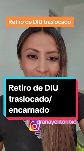Retiro de DIU Traslocado: Procedimiento Sencillo y Rápido