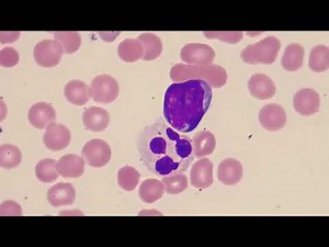 Lymphoblasts