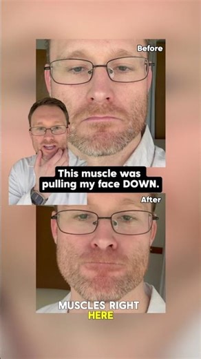 Stop letting this muscle frown for you 😕➡️🙂