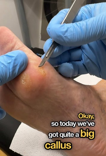 Expert Callus Removal for Big Toe Joint Issues