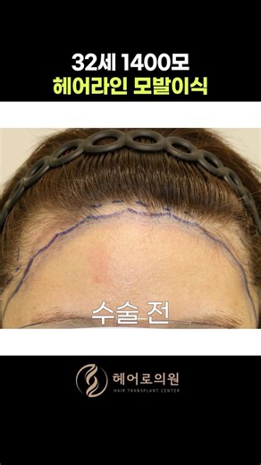 헤어라인 모발이식 1400모 1년 경과 후기!