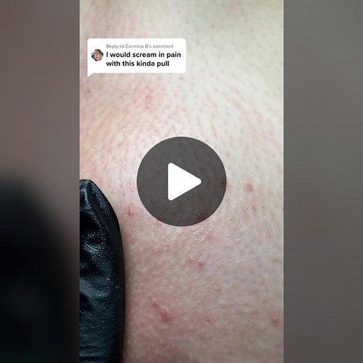 Replying to @Carmina B Comment below if you want me to show the wax I use/recommend! #foryou #fyp #viral #waxing #ingrownhair #extractions #satisfying