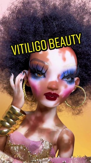 Celebrating Diversity: Vitiligo Beauty Dolls
