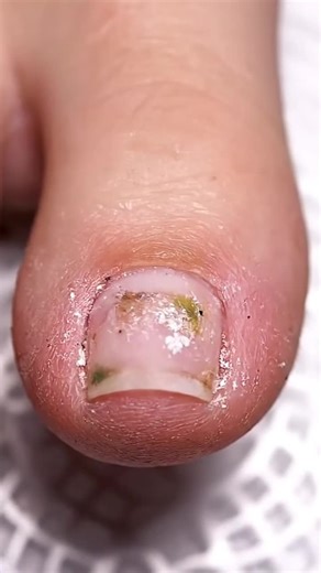 Pinky Toe Restoration and Deep Debris Removal