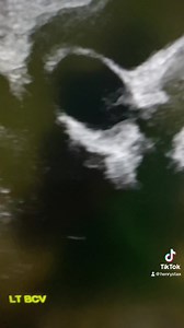 Great Vessel doppler | John Z Wetmore