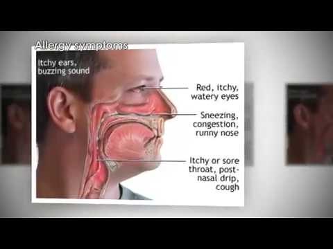 How Allergies Work Animation - Why Allergic Reactions Occur Video - Symptoms Sneezing Treatment