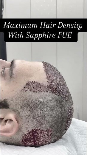 Perfect M Shape Hairline 💎 High Density Sapphire FUE Hair Transplant | Dr. Salman