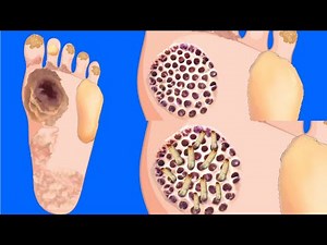 ASMR Foot Treatment Removal of Maggots Plantar Warts and Thick Dead Foot Skins