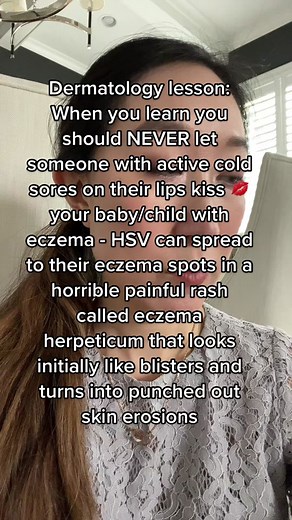 HSV or herpes Symplex virus, which is responsible for causing cold sores can lead to a painful and dangerous rash called #eczemaherpeticum in infants, kids, and more rarely adults with eczema or any other skin condition with an impaired skin barrier. Do not let anyone with an active cold sore outbreak around their mouth kiss your child if they have eczema! similarly if you have a cold sore please do not spread it to other people! I’ve seen several cases of eczema herpeticum in practice and the p