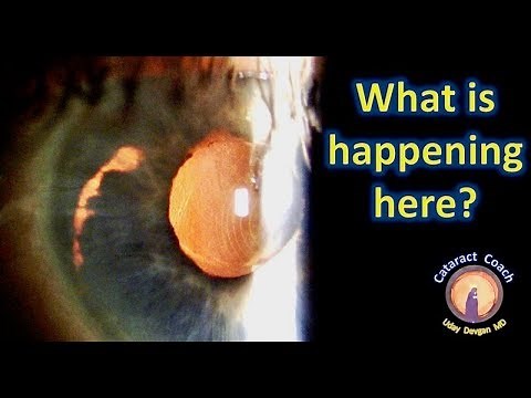 Why did this IOL dislocate after cataract surgery? And how can we fix it?