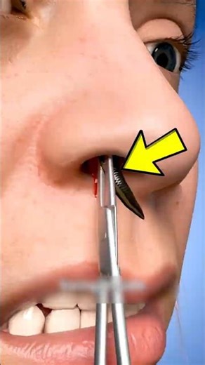 What To Do If a Leech Gets Inside Your Nose (Most People Panic!) #shorts