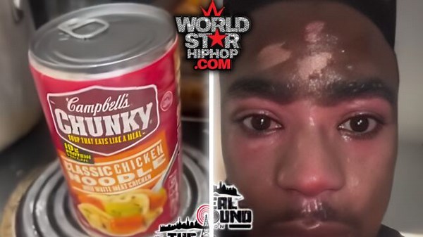 Man Tries To Show People How To Cook Soup In A Can And It Explodes In His Face, Leaving Him With Permanent Scars!