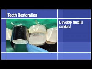 Anterior Restoration: Dual-Shade Build-Up Restoration of Two Anterior Teeth