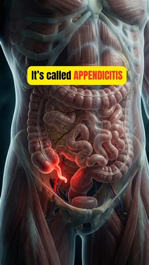 Appendicitis - The Pain You Should NEVER Ignore