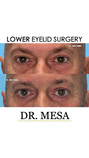 See the transformation before and after Eyelid Surgery #blepharoplasty #eyelidsurgery