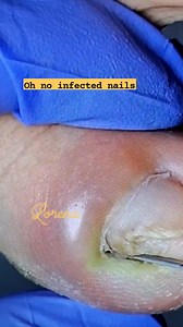 Infected nails with pus #needtreatment #toenails #fbreels2026ツ | Lorena Hilario Santiago
