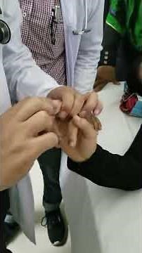 A positive Hoffman sign in a patient with Upper motor neuron lesion