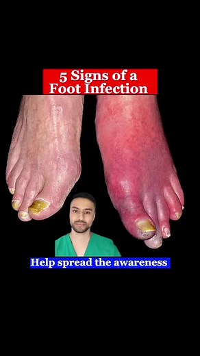 5 signs of a foot infection you should be aware of. This requires a course of antibiotics usually from your doctor. #fyp #medical #medicaltiktok #doctor #infection #antibiotics #thegoodfootdoctor