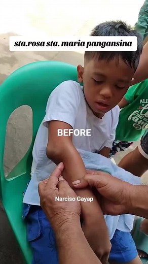 Emergency Dislocated Elbow Treatment