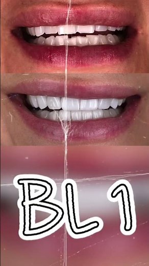 Which shade is your favorite? 🦷✨ From the brightest BL1 to the subtle elegance of BL4, every