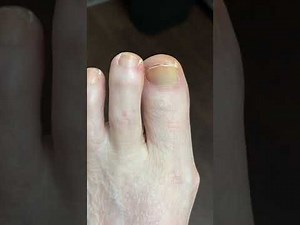 MINIMALLY INVASIVE SURGERY TO REMOVE A MONSTER BONE SPUR ❤️ 🦴 ❤️🦴❤️