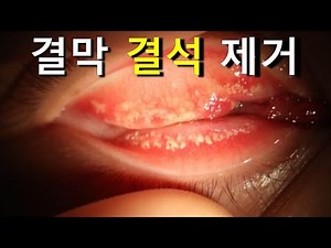 Conjunctival Concretion Removal