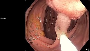 Live Resection of a Pedunculated Polyp