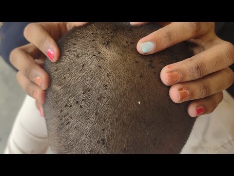 ASMR Lice Checking & Scalp Inspection (Fast & Satisfying) | No Talking