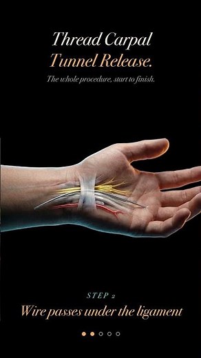 If your hands go numb at night, you need to see this.\n\nThe whole Thread Carpal Tunnel Release, start