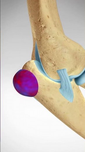 Triceps Tendon Avulsion and Repair #elbowpainrelief #elbowpain