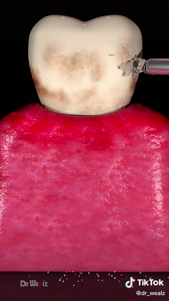 Dental Plaque Buildup Being Removed From Teeth #dental #teeth #plaque #animation #health