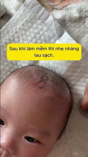 Tạm biệt “cứt trâu” cứng đầu chỉ với vài bước đơn giản tại nhà giúp da đầu bé sạch mịn😉 #meochamcon