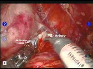 Robot Assisted Radical Prostatectomy (RARP) - Nerve Sparing • Video • MEDtube.net