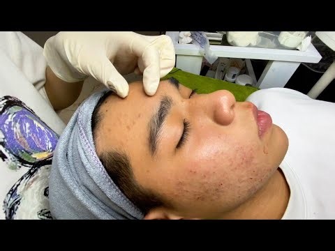 Severe Hidden Acne & Blackheads on Male Skin – Full Face Extraction | Spa Linh Mun #38