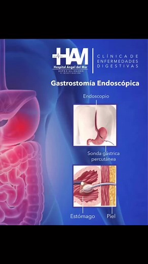 Gastrostomía Endoscópica Percutánea (GEP) ¿Qué es? 🤔 La gastrostomía endoscópica percutánea (GEP) es un procedimiento 🔪 el cual consiste en la colocación mediante endoscopia 🎦 de una sonda o tubo en el estómago a través de la pared abdominal. ¿Como se realiza? 🧐 Se puede realizar bajo anestesia local💉 , un endoscopio 🎦 se introduce por la boca 👄 , baja por el esófago ⬇️ y se introduce en el estómago. Luego, se puede ver la pared del estómago a través de la cual pasará la sonda gástrica pe