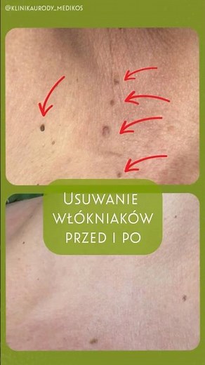 📌Usuwanie włókniaków - efekt przed i po zabiegu. #wlokniaki #skóra #kosmetologgdynia