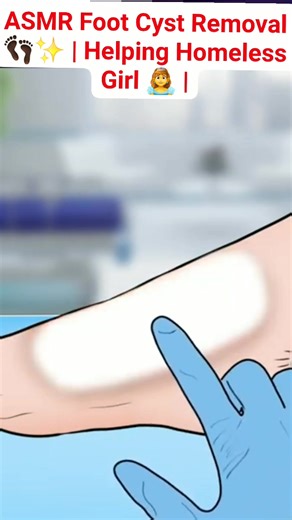 ASMR Foot Cyst Removal 👣✨ | Helping Homeless Girl 👸 | #reels #video #animation #treatment | Akhilesh Yadav