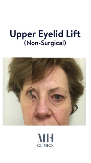 This before-and-after demonstrates how AGNES RF can precisely lift and refine upper eyelid laxity — without surgical intervention. 〰️ Shown here: 12 months following a second treatment. AGNES RF is a doctor-only procedure designed for delicate eye anatomy. Using micro-insulated needles, controlled radio-frequency energy is delivered into specific tissue layers to stimulate collagen, tighten skin, and accurately treat small fat pockets. Treatment planning is based on individual anatomy, skin qual
