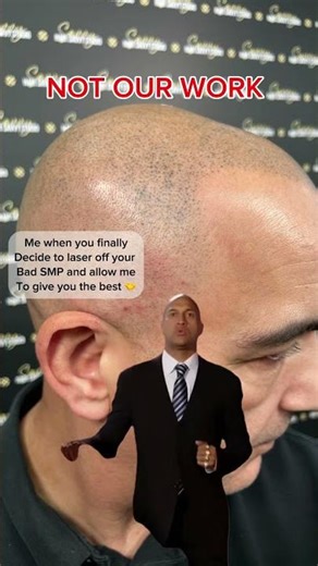 Bad SMP? We can laser it and give your the SMP you deserve! #laserremoval #scalpmicropigmentation