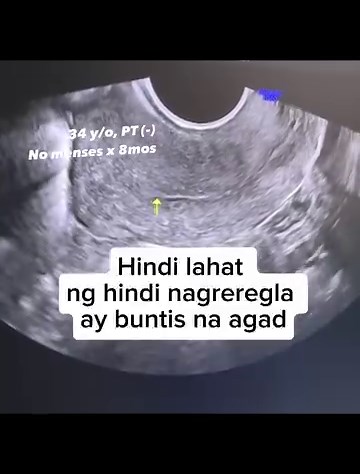 Primary ovarian insufficiency (POI), previously known as premature ovarian failure, happens when a woman's ovaries stop working normally before she is 40. We usually do blood tests to check hormone levels and rule out pregnancy, thyroid disease, and other health conditions. #ObGynLife #ObGynUltrasound #ObGynUltrasoundSubspecialist | Snippets of OBGYN Life