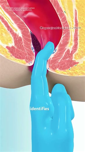 How hemorrhoid removal surgery is performed?(3D animation) #motivation #epic #medicalnewstoday