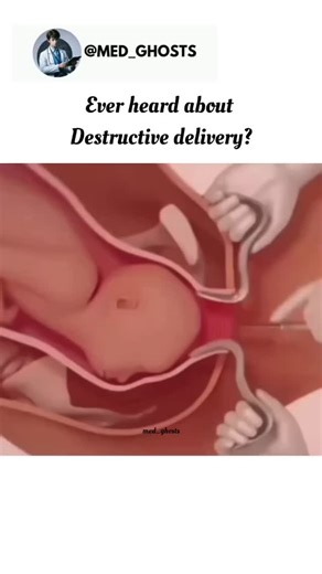 Medical Insights | 🩺 In cases of fetal demise, destructive delivery is a procedure where the fetus is dismembered or broken down to facilitate delivery,... | Instagram